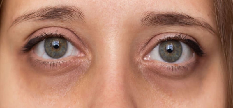 Dark Circles