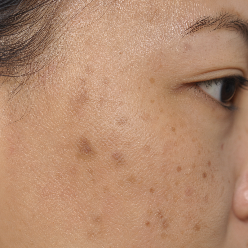 Dark Spots