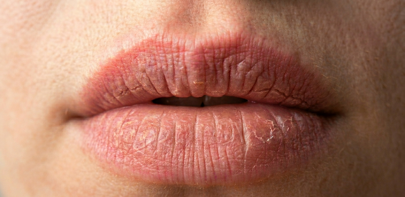 Chapped Lips